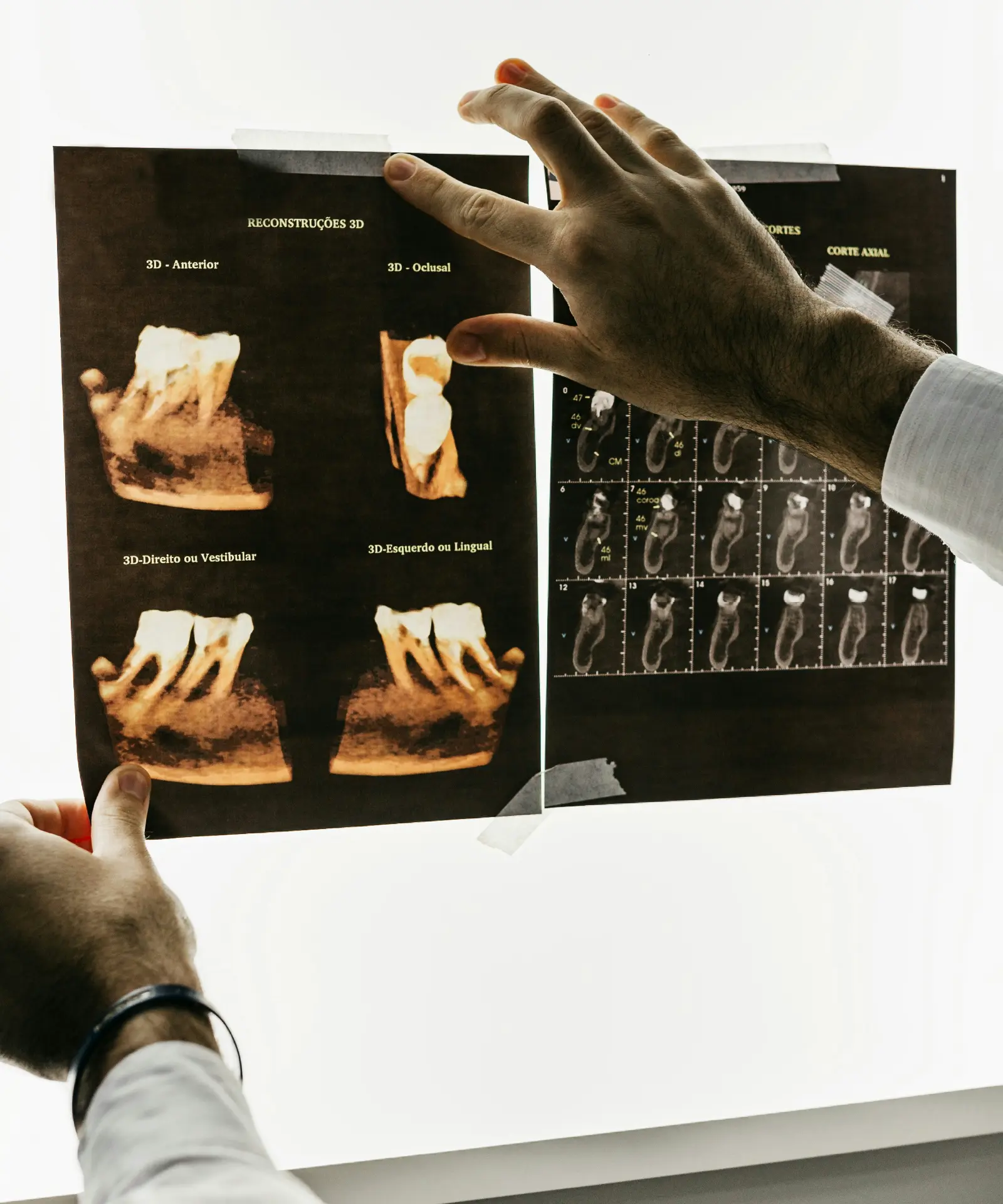 Bone Regeneration